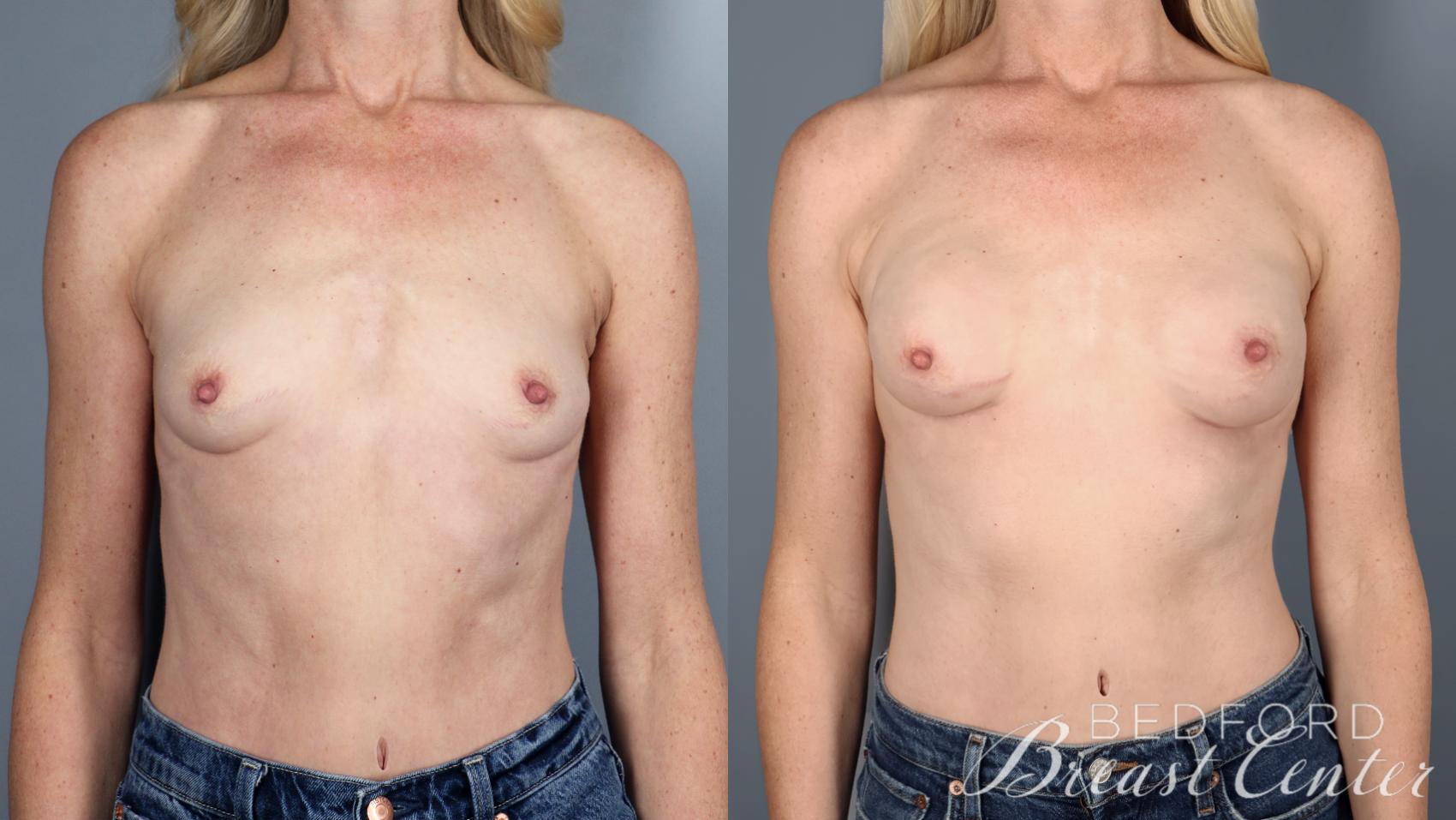 Before & After Nipple Sparing Mastectomy with One-Stage Breast Reconstruction Case 37 Front View in Beverly Hills, Los Angeles, Santa Monica, Glendale, and Malibu, CA