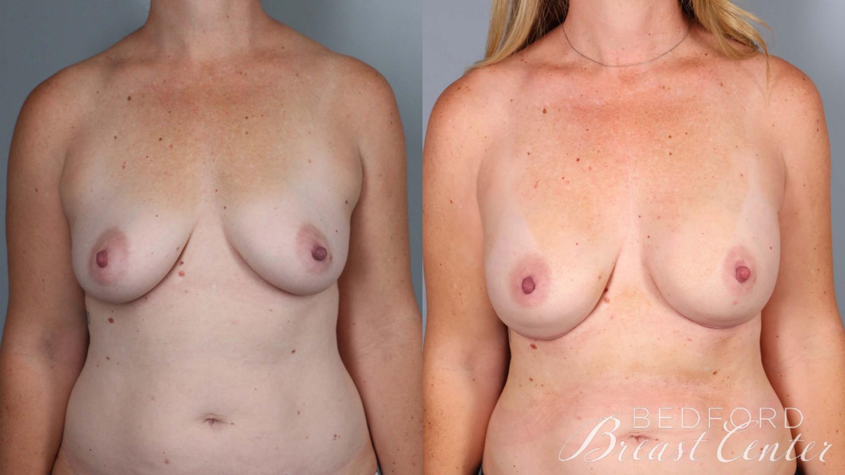 Before & After Nipple Sparing Mastectomy with One-Stage Breast Reconstruction Case 38 Front View in Beverly Hills, Los Angeles, Santa Monica, Glendale, and Malibu, CA