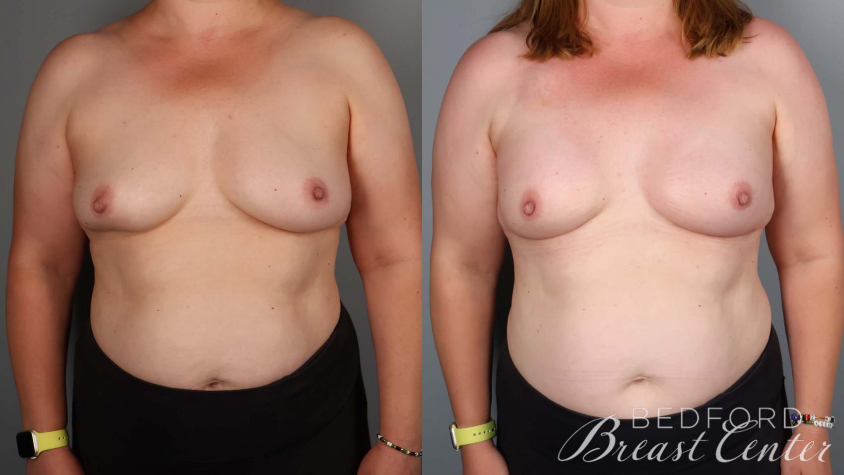 Before & After Nipple Sparing Mastectomy with One-Stage Breast Reconstruction Case 39 Front View in Beverly Hills, Los Angeles, Santa Monica, Glendale, and Malibu, CA