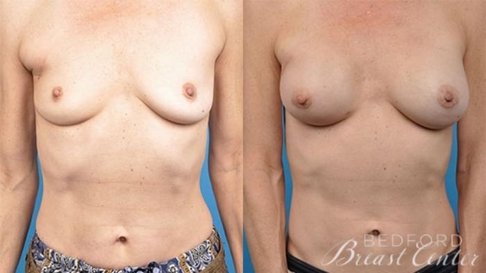 Before & After Breast Reconstruction Revision Case 13 Front View in Beverly Hills, Los Angeles, Santa Monica, Glendale, and Malibu, CA
