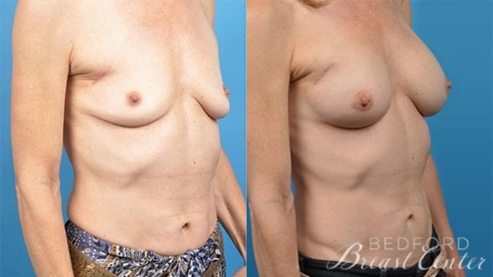 Before & After Breast Reconstruction Revision Case 13 Right Oblique View in Beverly Hills, Los Angeles, Santa Monica, Glendale, and Malibu, CA