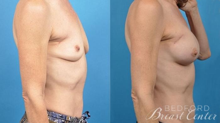 Before & After Breast Reconstruction Revision Case 13 Right Side View in Beverly Hills, Los Angeles, Santa Monica, Glendale, and Malibu, CA