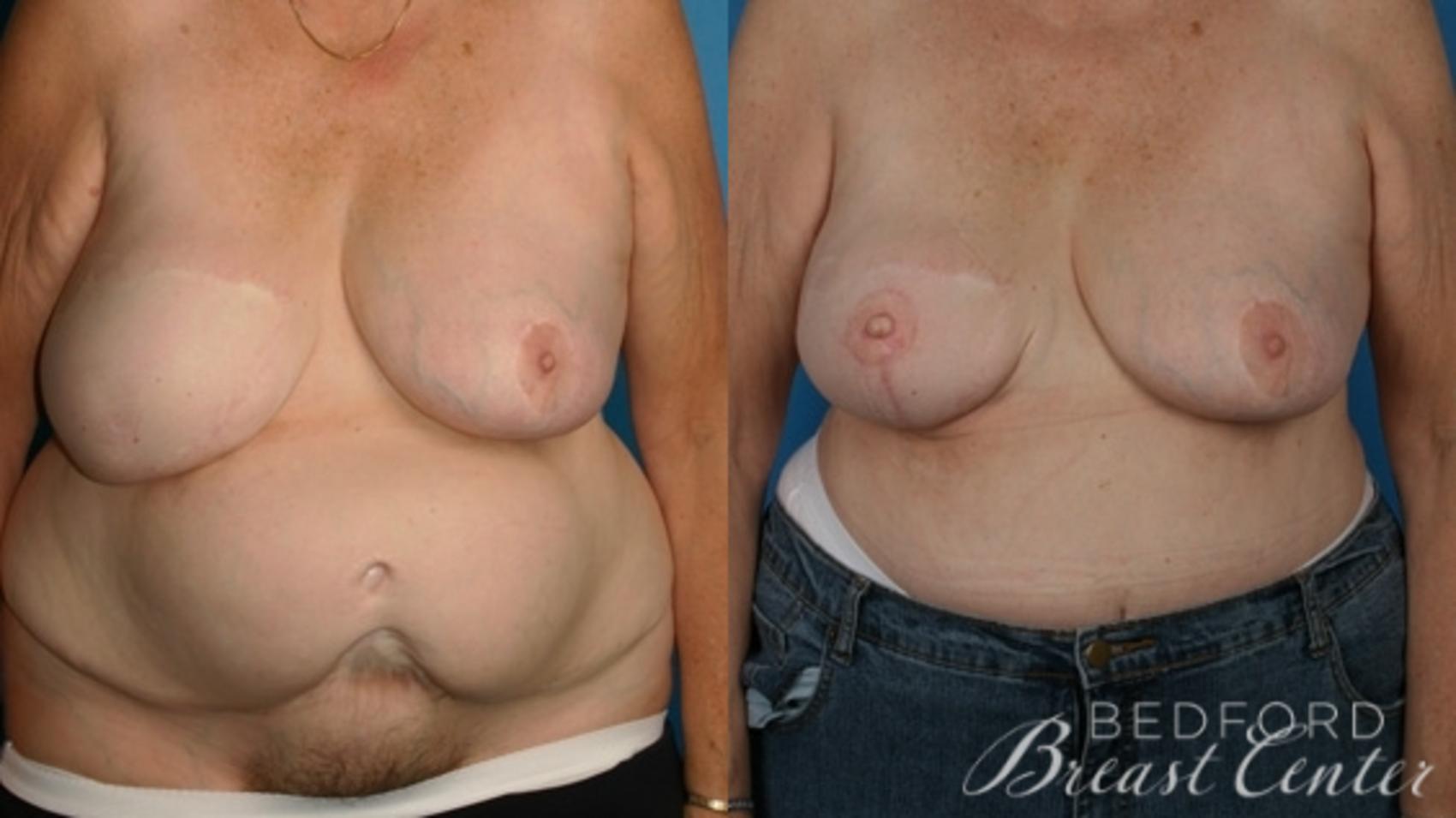 Before & After Breast Reconstruction Revision Case 14 Front View in Beverly Hills, Los Angeles, Santa Monica, Glendale, and Malibu, CA