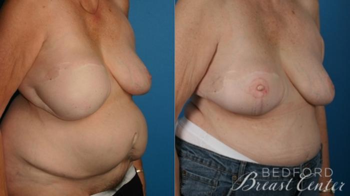 Before & After Breast Reconstruction Revision Case 14 Right Oblique View in Beverly Hills, Los Angeles, Santa Monica, Glendale, and Malibu, CA