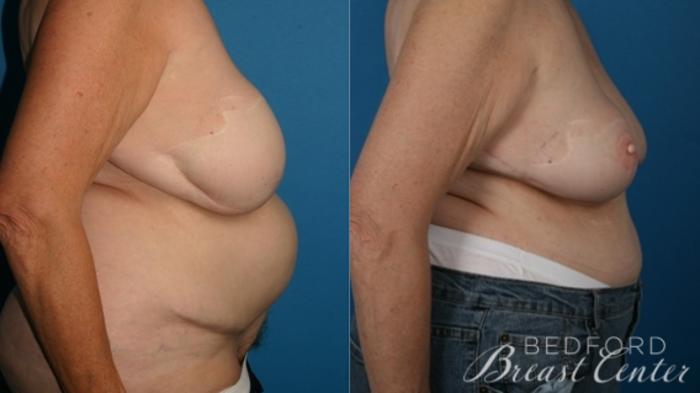 Before & After Breast Reconstruction Revision Case 14 Right Side View in Beverly Hills, Los Angeles, Santa Monica, Glendale, and Malibu, CA