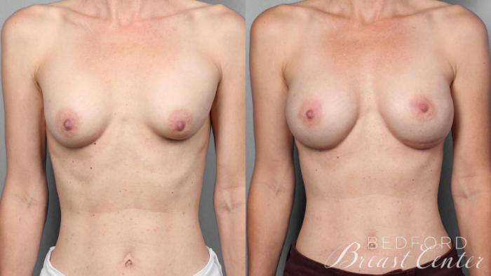 Before & After Breast Reconstruction Revision Case 21 Front View in Beverly Hills, Los Angeles, Santa Monica, Glendale, and Malibu, CA