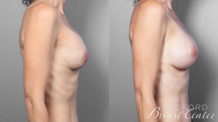 Before & After Breast Reconstruction Revision Case 21 Right Side View in Beverly Hills, Los Angeles, Santa Monica, Glendale, and Malibu, CA