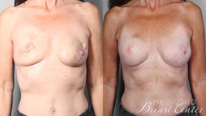 Before & After Breast Reconstruction Revision Case 22 Front View in Beverly Hills, Los Angeles, Santa Monica, Glendale, and Malibu, CA