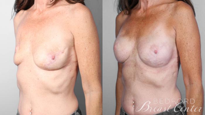 Before & After Breast Reconstruction Revision Case 22 Left Oblique View in Beverly Hills, Los Angeles, Santa Monica, Glendale, and Malibu, CA