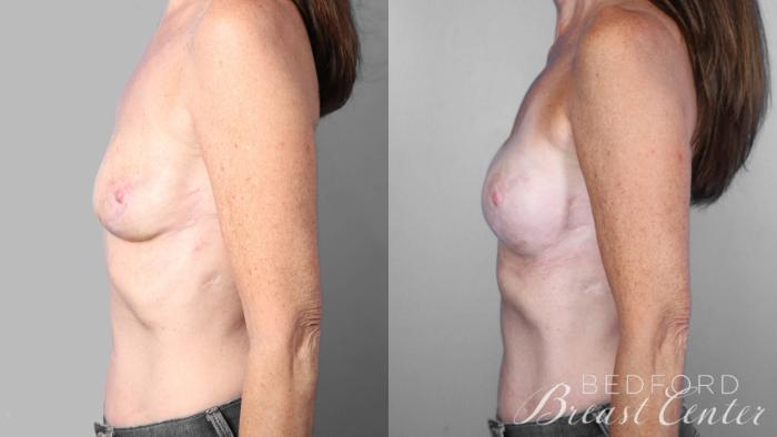 Before & After Breast Reconstruction Revision Case 22 Left Side View in Beverly Hills, Los Angeles, Santa Monica, Glendale, and Malibu, CA