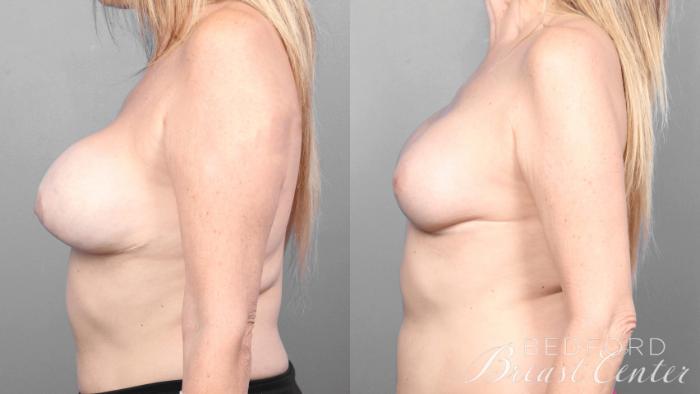 Before & After Breast Reconstruction Revision Case 23 Left Side View in Beverly Hills, Los Angeles, Santa Monica, Glendale, and Malibu, CA