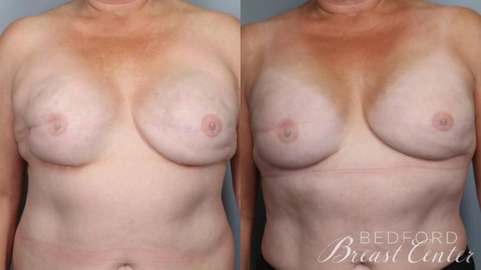 Before & After Breast Reconstruction Revision Case 24 Front View in Beverly Hills, Los Angeles, Santa Monica, Glendale, and Malibu, CA