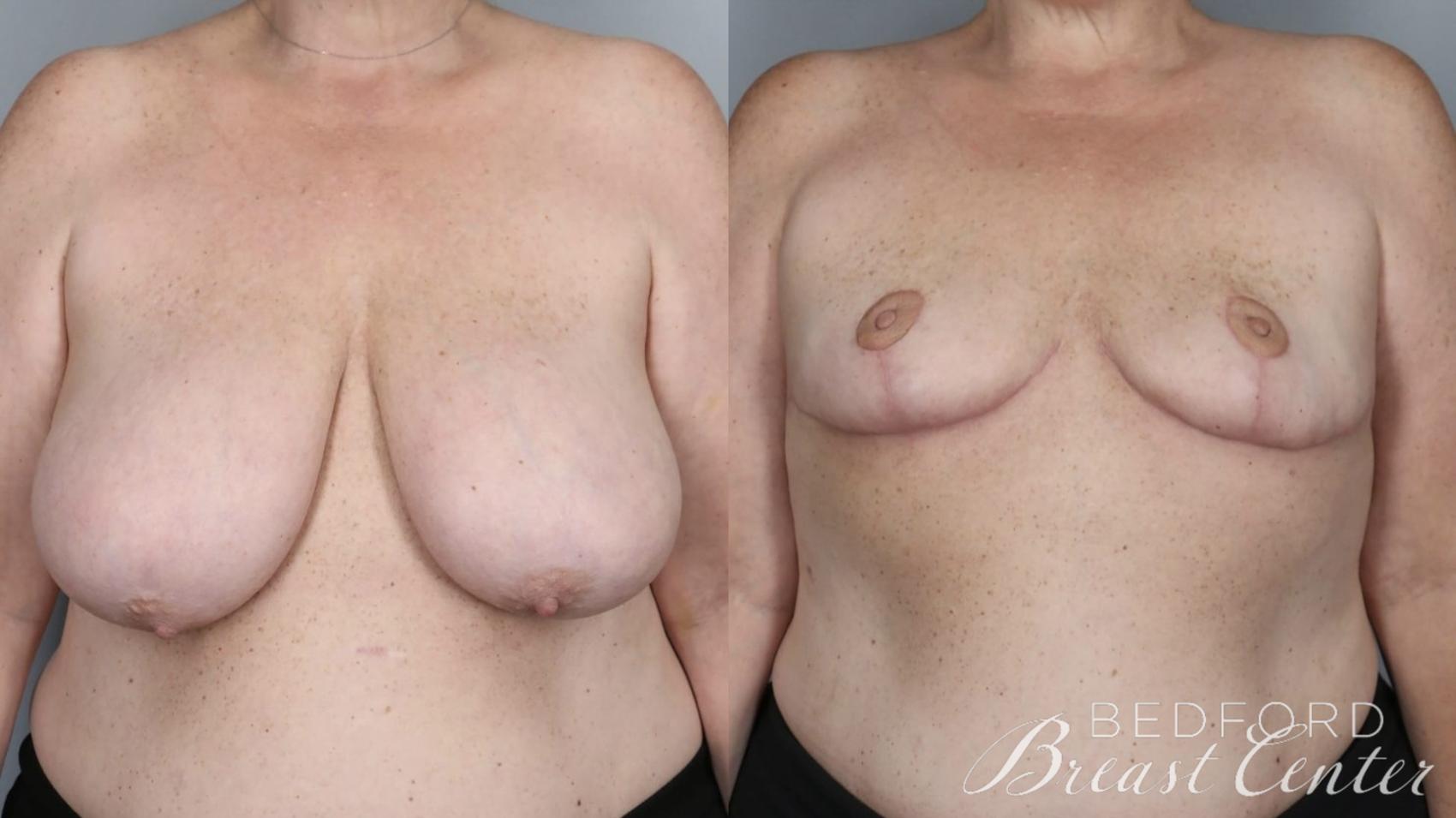 Before & After Goldilocks Mastectomy with SWIM Flap Breast Reconstruction Case 15 Front View in Beverly Hills, Los Angeles, Santa Monica, Glendale, and Malibu, CA