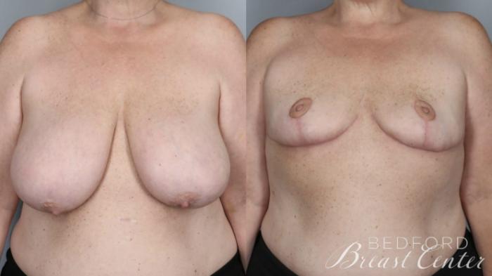 Before & After Goldilocks Mastectomy with SWIM Flap Breast Reconstruction Case 15 Front View in Beverly Hills, CA