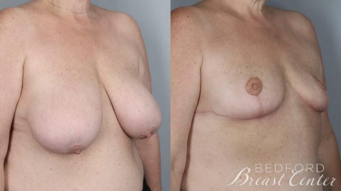 Before & After Goldilocks Mastectomy with SWIM Flap Breast Reconstruction Case 15 Right Oblique View in Beverly Hills, Los Angeles, Santa Monica, Glendale, and Malibu, CA