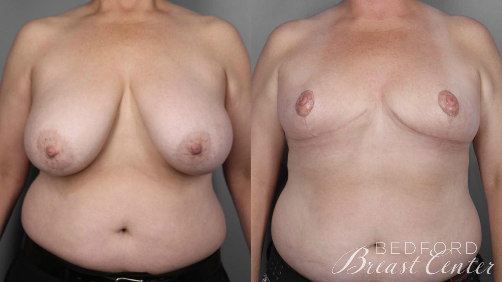 Before & After Goldilocks Mastectomy with SWIM Flap Breast Reconstruction Case 16 Front View in Beverly Hills, Los Angeles, Santa Monica, Glendale, and Malibu, CA