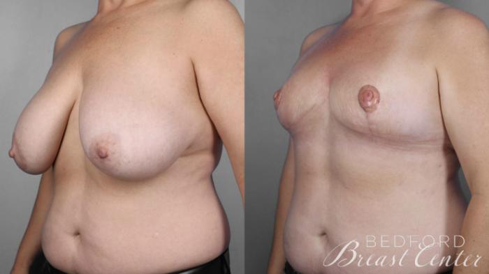 Before & After Goldilocks Mastectomy with SWIM Flap Breast Reconstruction Case 16 Left Oblique View in Beverly Hills, Los Angeles, Santa Monica, Glendale, and Malibu, CA