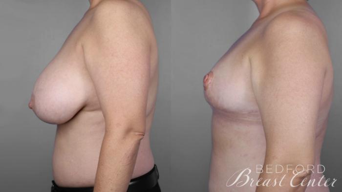 Before & After Goldilocks Mastectomy with SWIM Flap Breast Reconstruction Case 16 Left Side View in Beverly Hills, Los Angeles, Santa Monica, Glendale, and Malibu, CA
