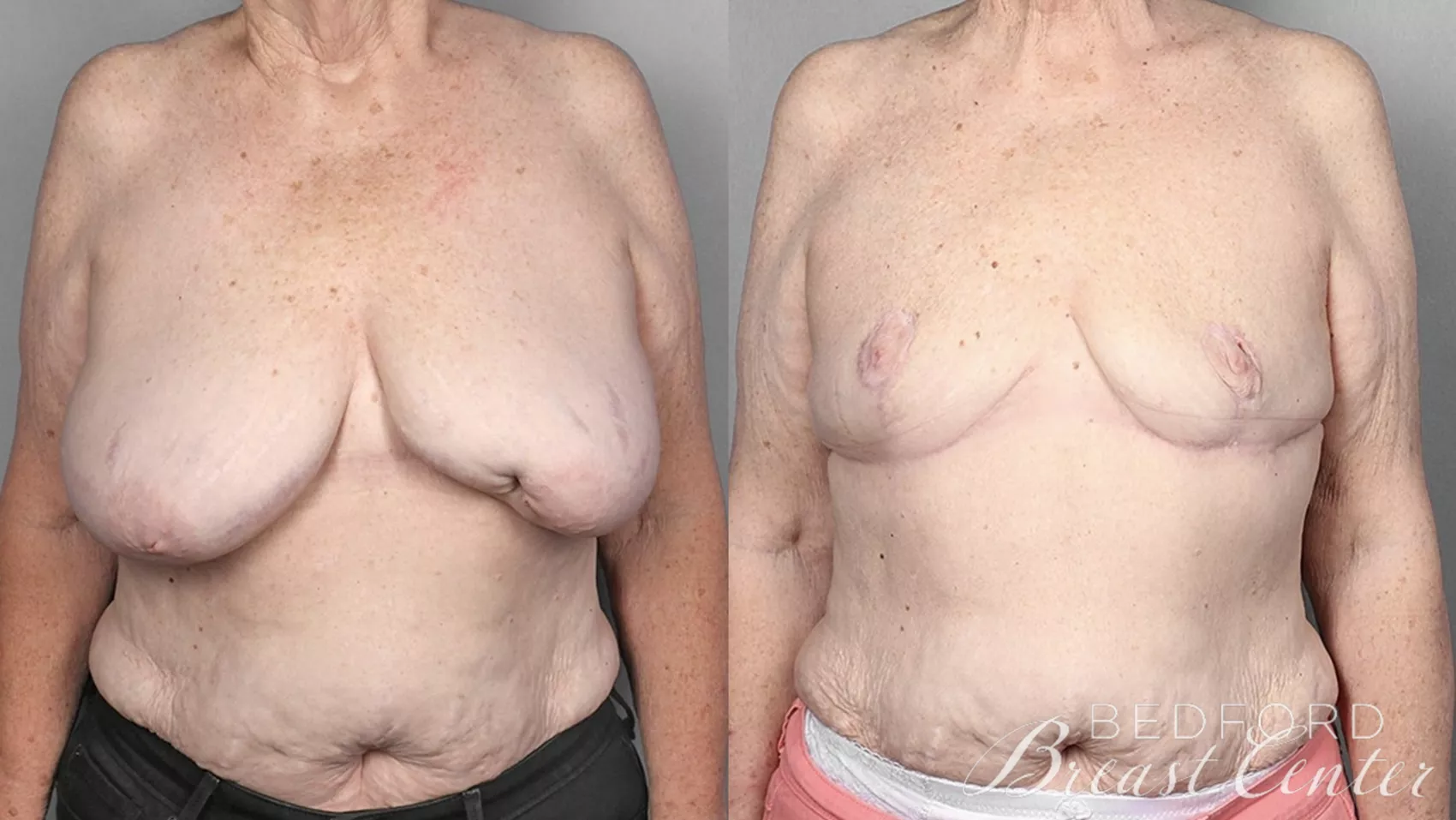 Goldilocks Mastectomy with SWIM Flap Breast Reconstruction Before