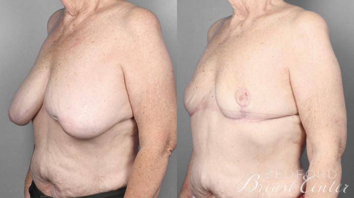 Before & After Goldilocks Mastectomy with SWIM Flap Breast Reconstruction Case 17 Left Oblique View in Beverly Hills, CA