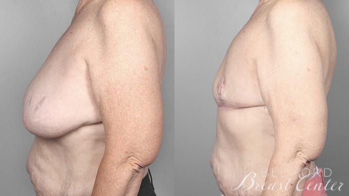 Before & After Goldilocks Mastectomy with SWIM Flap Breast Reconstruction Case 17 Left Side View in Beverly Hills, Los Angeles, Santa Monica, Glendale, and Malibu, CA