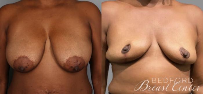 Before & After Goldilocks Mastectomy with SWIM Flap Breast Reconstruction Case 20 Front View in Beverly Hills, Los Angeles, Santa Monica, Glendale, and Malibu, CA