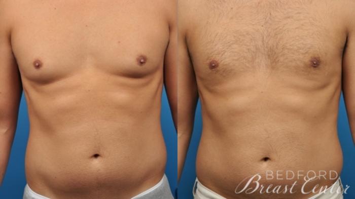 Before & After Gynecomastia Case 18 Front View in Beverly Hills, Los Angeles, Santa Monica, Glendale, and Malibu, CA