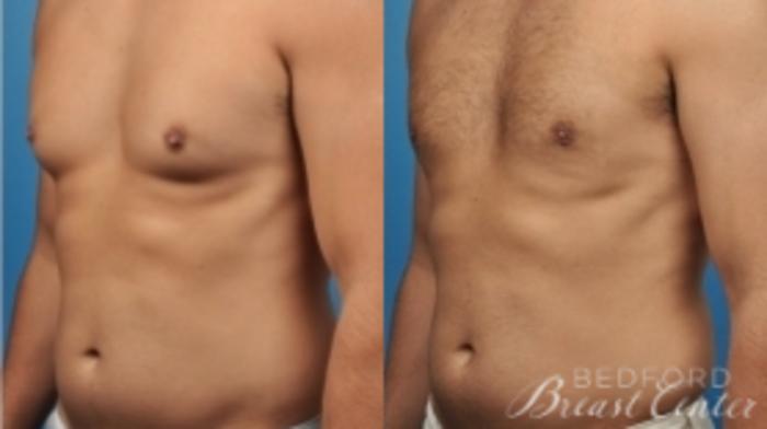 Before & After Gynecomastia Case 18 Left Oblique View in Beverly Hills, Los Angeles, Santa Monica, Glendale, and Malibu, CA