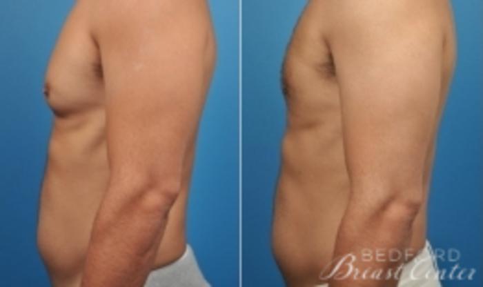 Before & After Gynecomastia Case 18 Left Side View in Beverly Hills, Los Angeles, Santa Monica, Glendale, and Malibu, CA