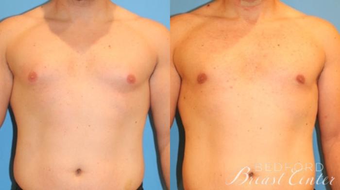 Before & After Gynecomastia Case 19 Front View in Beverly Hills, Los Angeles, Santa Monica, Glendale, and Malibu, CA