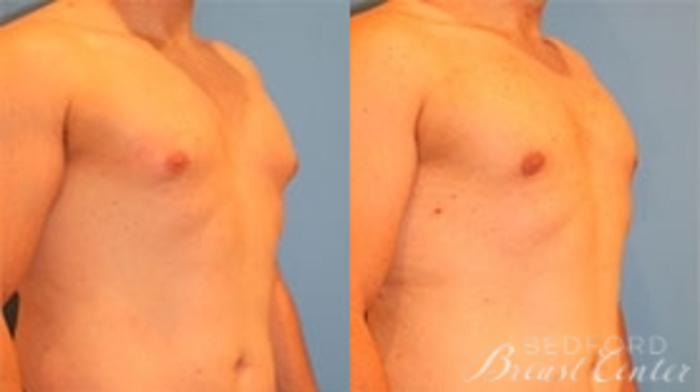 Before & After Gynecomastia Case 19 Right Oblique View in Beverly Hills, Los Angeles, Santa Monica, Glendale, and Malibu, CA