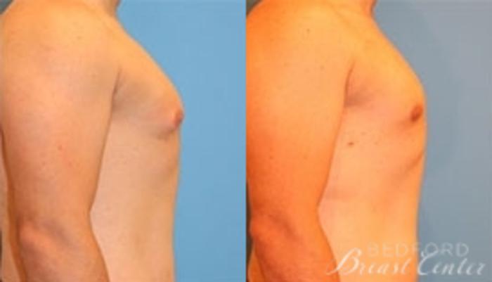 Before & After Gynecomastia Case 19 Right Side View in Beverly Hills, Los Angeles, Santa Monica, Glendale, and Malibu, CA