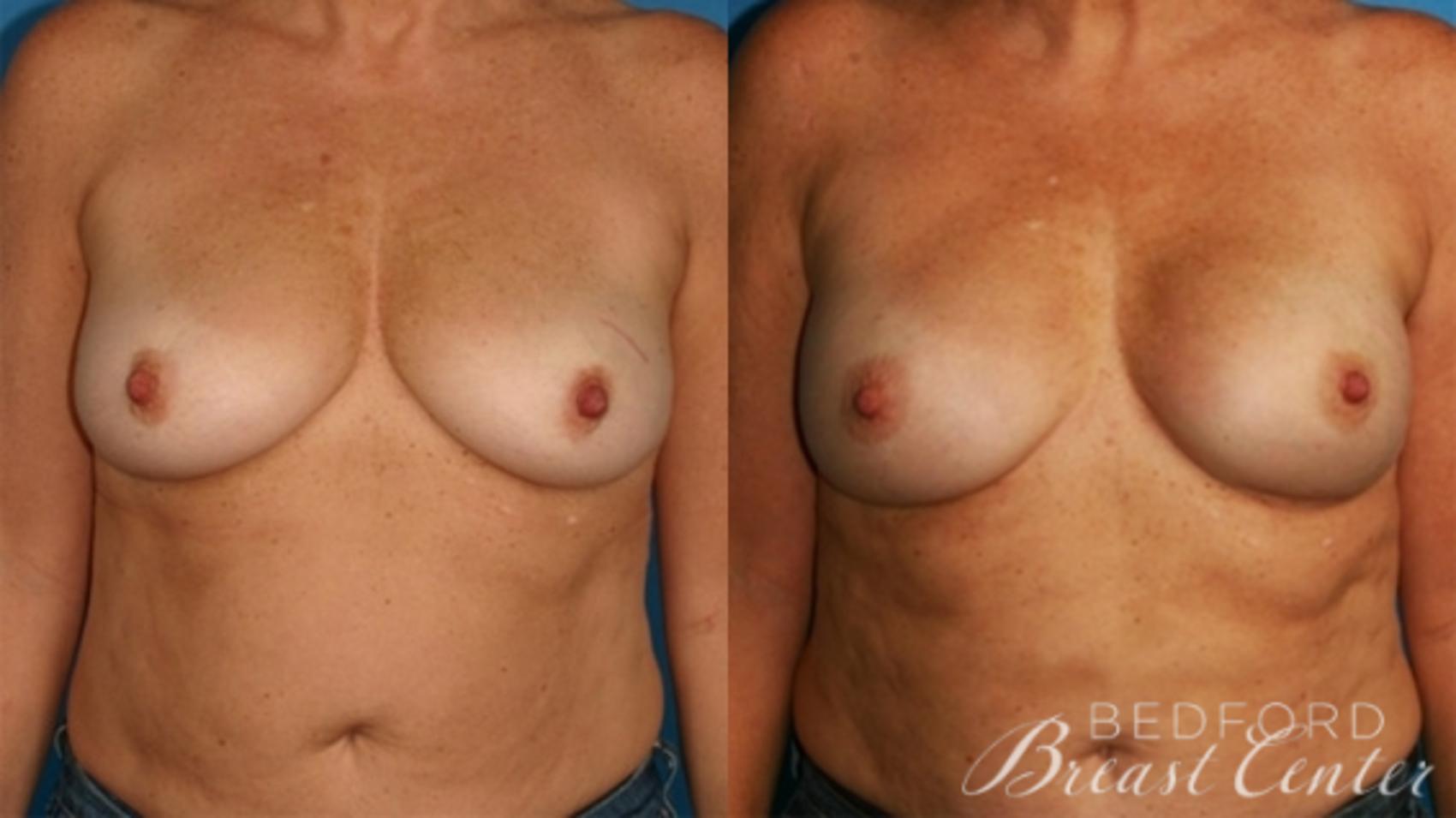 Before & After Nipple Sparing Mastectomy with One-Stage Breast Reconstruction Case 10 Front View in Beverly Hills, Los Angeles, Santa Monica, Glendale, and Malibu, CA