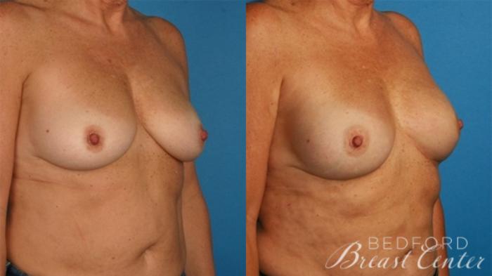 Before & After Nipple Sparing Mastectomy with One-Stage Breast Reconstruction Case 10 Right Oblique View in Beverly Hills, Los Angeles, Santa Monica, Glendale, and Malibu, CA