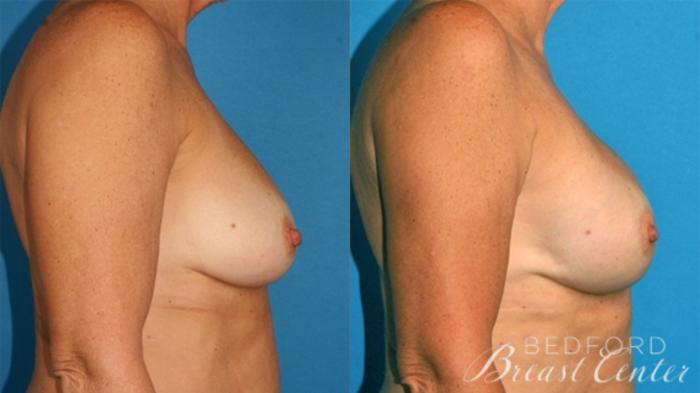 Before & After Nipple Sparing Mastectomy with One-Stage Breast Reconstruction Case 10 Right Side View in Beverly Hills, Los Angeles, Santa Monica, Glendale, and Malibu, CA