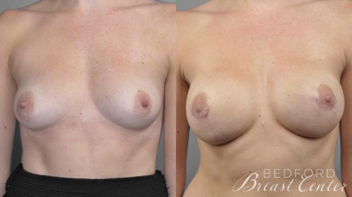 Before & After Nipple Sparing Mastectomy with One-Stage Breast Reconstruction Case 11 Front View in Beverly Hills, Los Angeles, Santa Monica, Glendale, and Malibu, CA