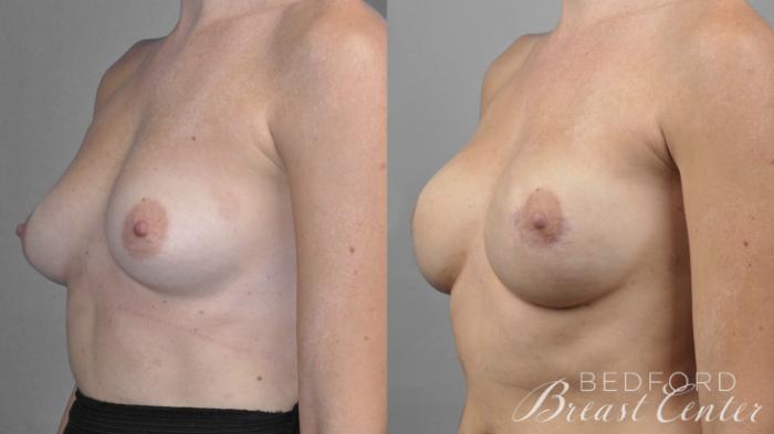 Before & After Nipple Sparing Mastectomy with One-Stage Breast Reconstruction Case 11 Left Oblique View in Beverly Hills, Los Angeles, Santa Monica, Glendale, and Malibu, CA