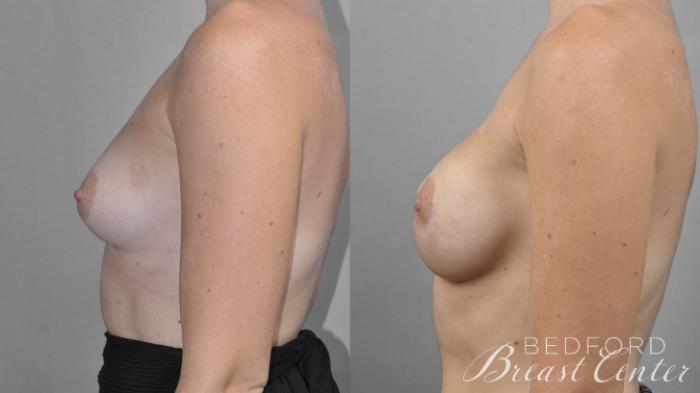 Before & After Nipple Sparing Mastectomy with One-Stage Breast Reconstruction Case 11 Left Side View in Beverly Hills, Los Angeles, Santa Monica, Glendale, and Malibu, CA