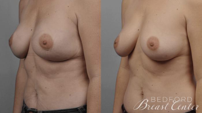 Before & After Nipple Sparing Mastectomy with One-Stage Breast Reconstruction Case 12 Left Oblique View in Beverly Hills, Los Angeles, Santa Monica, Glendale, and Malibu, CA