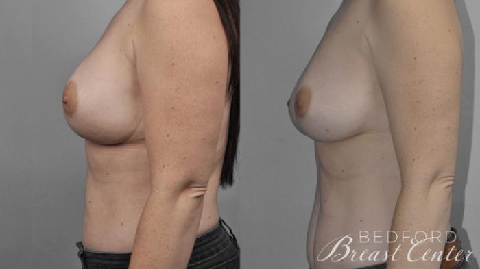 Before & After Nipple Sparing Mastectomy with One-Stage Breast Reconstruction Case 12 Left Side View in Beverly Hills, Los Angeles, Santa Monica, Glendale, and Malibu, CA
