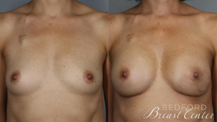 Before & After Nipple Sparing Mastectomy with One-Stage Breast Reconstruction Case 25 Front View in Beverly Hills, Los Angeles, Santa Monica, Glendale, and Malibu, CA