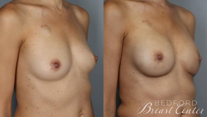 Before & After Nipple Sparing Mastectomy with One-Stage Breast Reconstruction Case 25 Right Oblique View in Beverly Hills, Los Angeles, Santa Monica, Glendale, and Malibu, CA