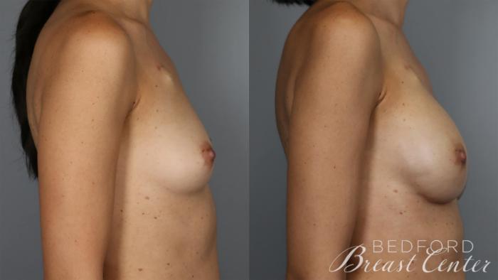 Before & After Nipple Sparing Mastectomy with One-Stage Breast Reconstruction Case 25 Right Side View in Beverly Hills, Los Angeles, Santa Monica, Glendale, and Malibu, CA