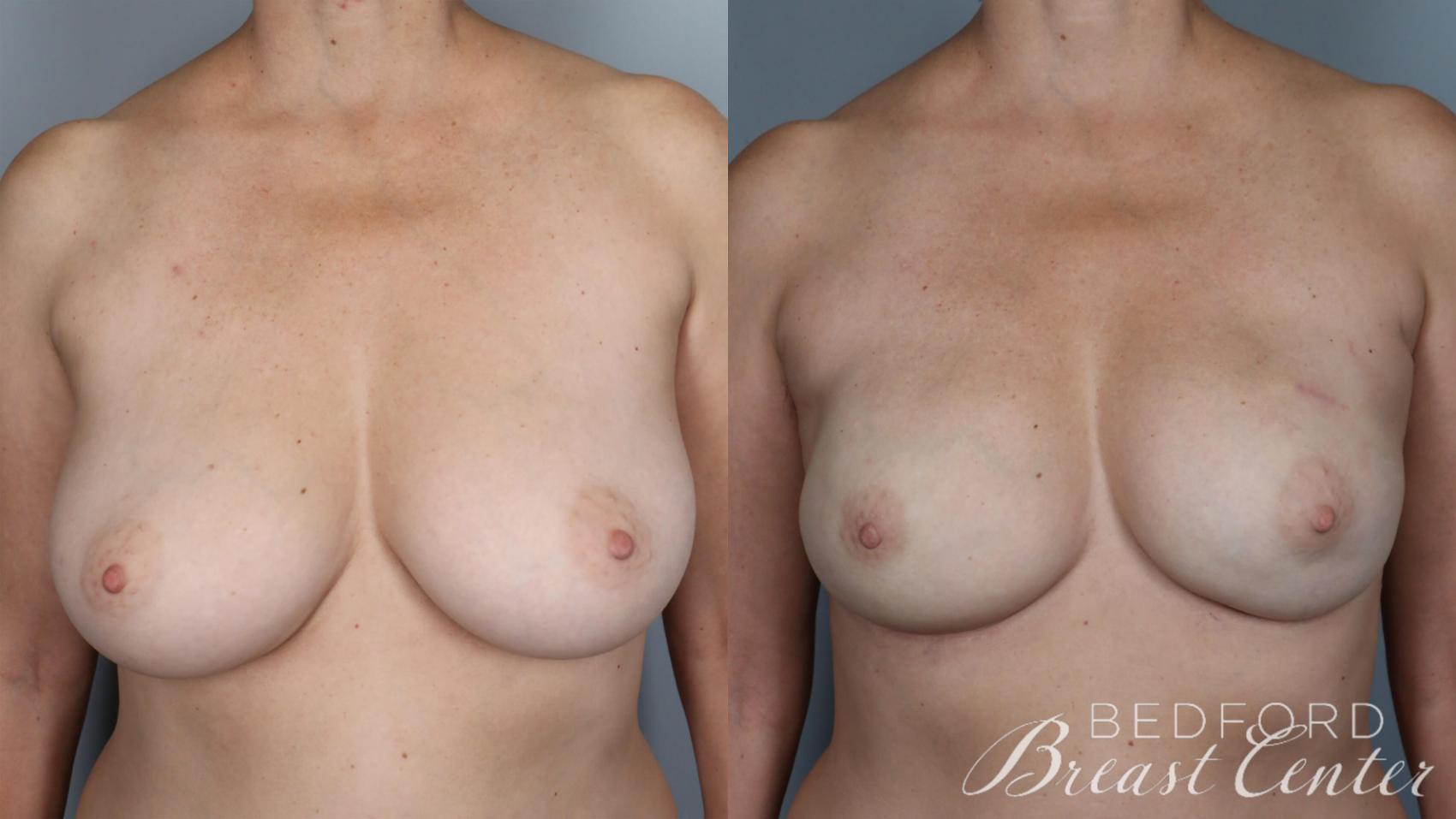 Before & After Nipple Sparing Mastectomy with One-Stage Breast Reconstruction Case 26 Front View in Beverly Hills, Los Angeles, Santa Monica, Glendale, and Malibu, CA