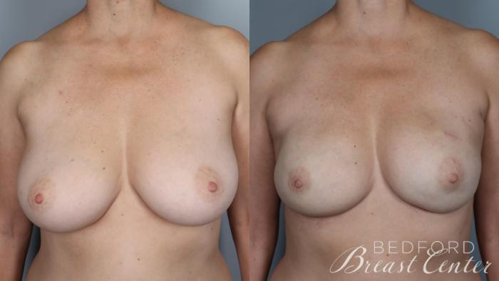 Before & After Nipple Sparing Mastectomy with One-Stage Breast Reconstruction Case 26 Front View in Beverly Hills, Los Angeles, Santa Monica, Glendale, and Malibu, CA