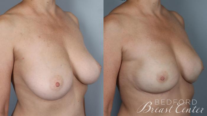 Before & After Nipple Sparing Mastectomy with One-Stage Breast Reconstruction Case 26 Right Oblique View in Beverly Hills, Los Angeles, Santa Monica, Glendale, and Malibu, CA