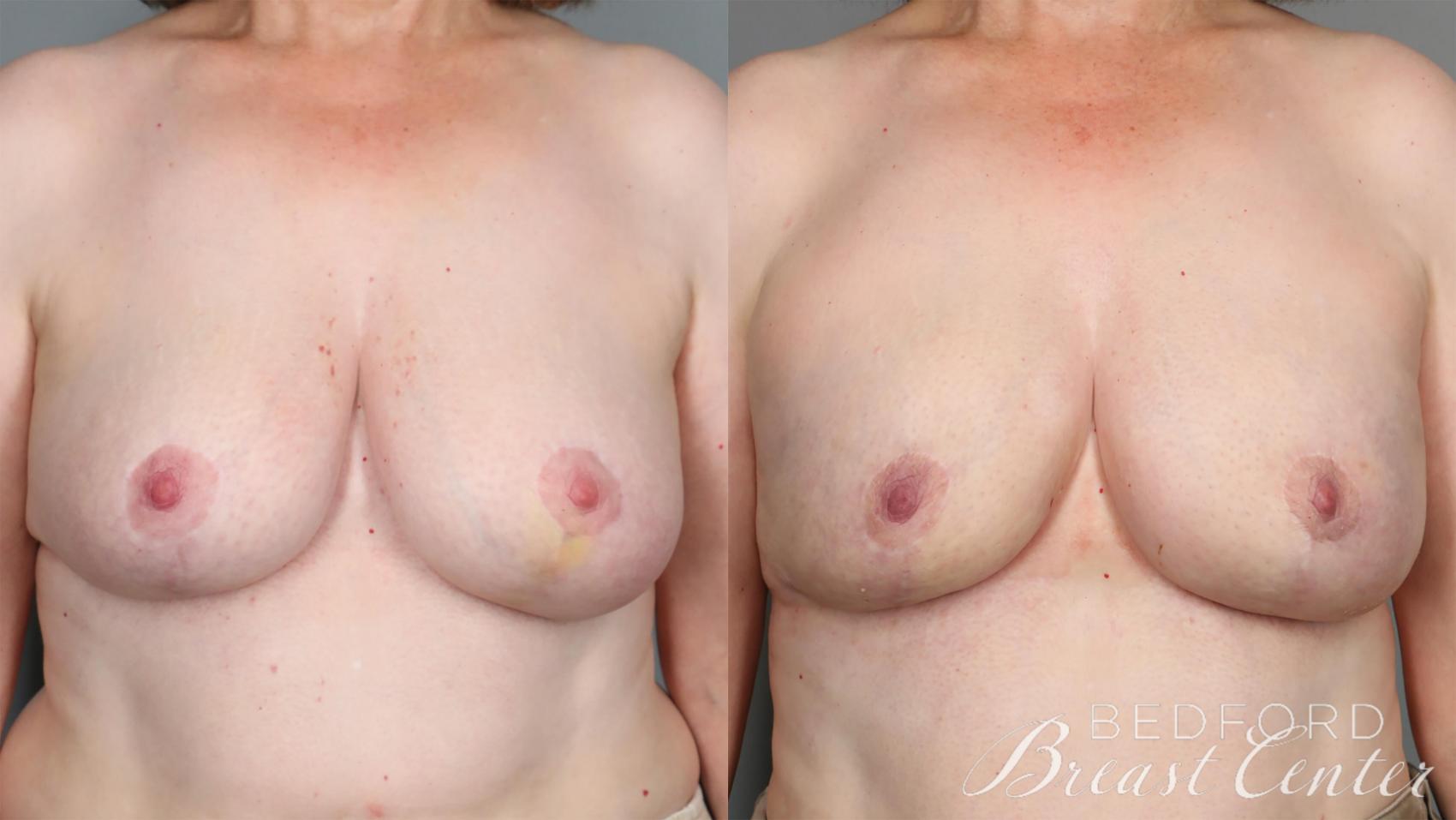Before & After Nipple Sparing Mastectomy with One-Stage Breast Reconstruction Case 27 Front View in Beverly Hills, Los Angeles, Santa Monica, Glendale, and Malibu, CA