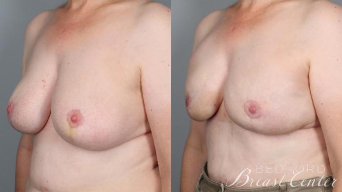 Before & After Nipple Sparing Mastectomy with One-Stage Breast Reconstruction Case 27 Left Oblique View in Beverly Hills, Los Angeles, Santa Monica, Glendale, and Malibu, CA
