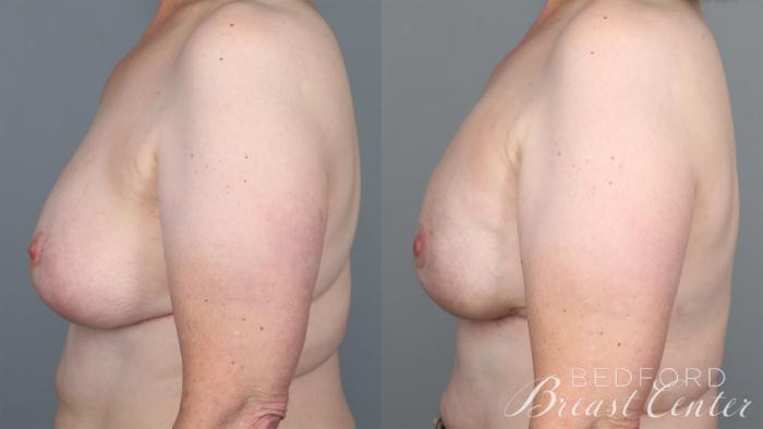 Before & After Nipple Sparing Mastectomy with One-Stage Breast Reconstruction Case 27 Left Side View in Beverly Hills, Los Angeles, Santa Monica, Glendale, and Malibu, CA