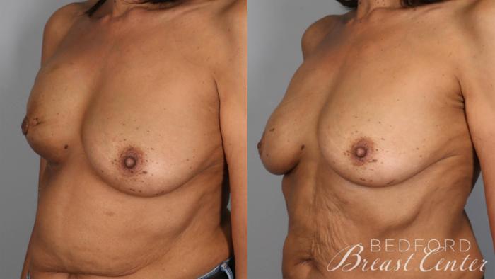 Before & After Nipple Sparing Mastectomy with One-Stage Breast Reconstruction Case 28 Left Oblique View in Beverly Hills, Los Angeles, Santa Monica, Glendale, and Malibu, CA